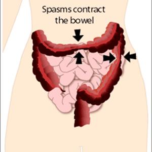 Mayo Clinic Spastic Colon Symptoms - What Is Irritable Bowel Syndrom (IBS)